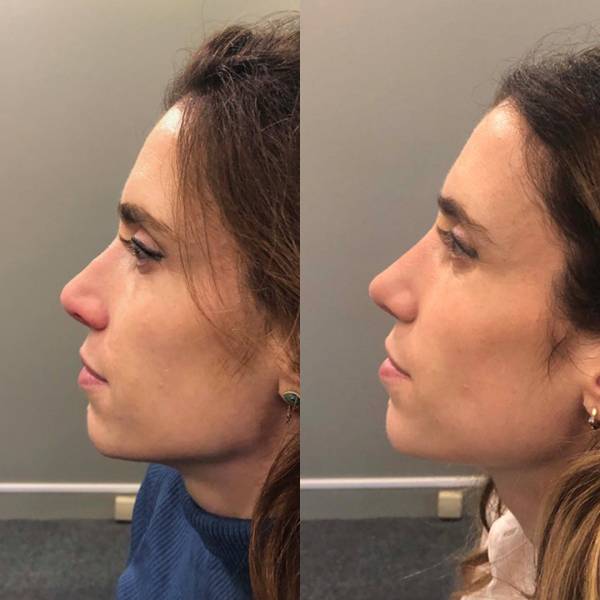 rhinoplastie secondaire dr azan paris