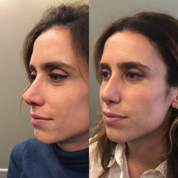 rhinoplastie secondaire dr azan paris