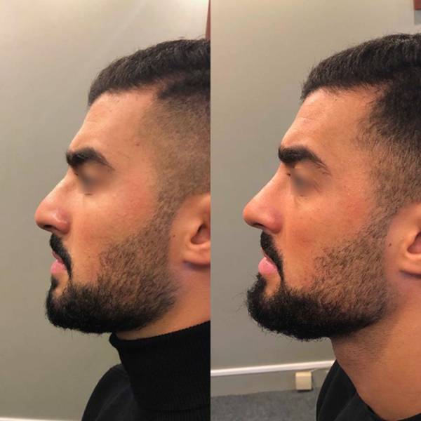 resultat rhinoplastie homme