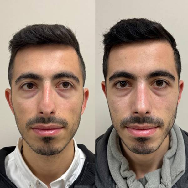 resultat rhinoplastie avant après dr susini paris