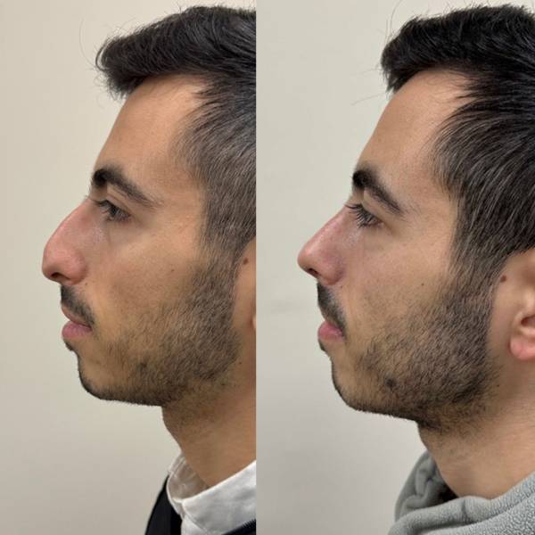 resultat rhinoplastie avant après dr susini paris