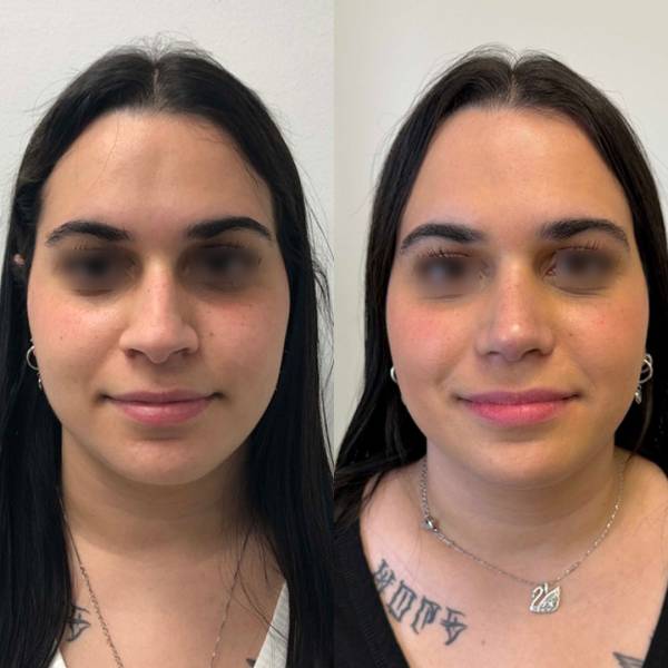 resultat rhinoplastie dr azan avant apres